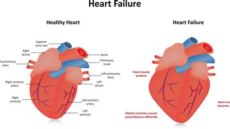 global hypokinesia of lv meaning|severe hypokinesis of left ventricle.